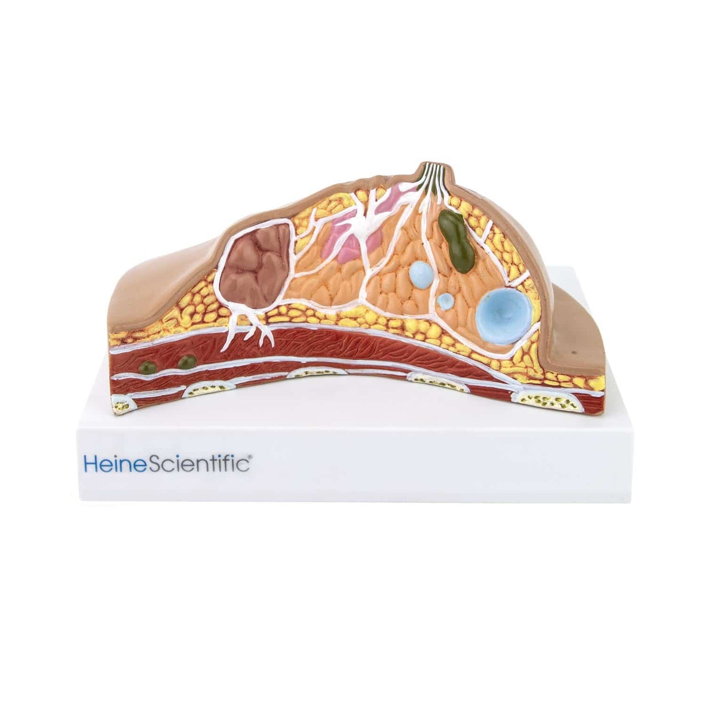 Female Breast Model With Diseases From Heinescientific