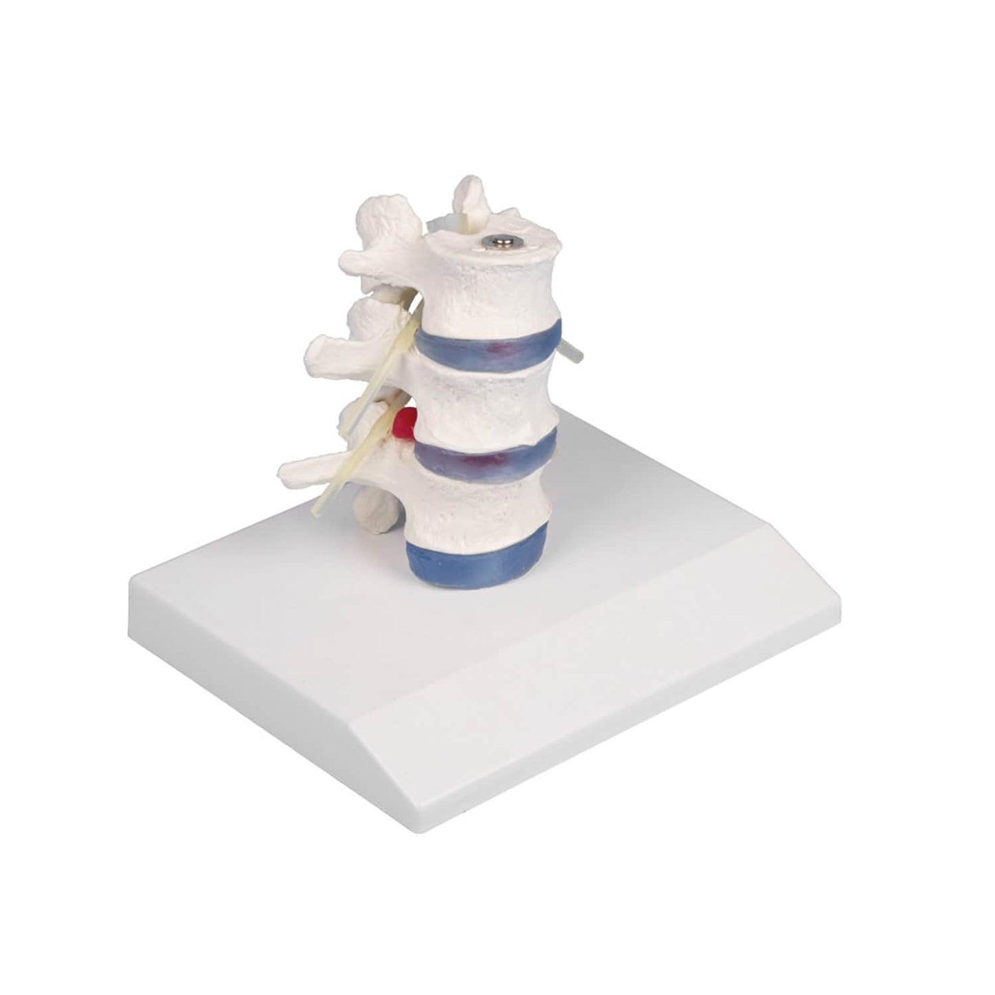 Lumbar Vertebra With Herniated Disc By Erler-Zimmer Mounted On A Stand (Removable)