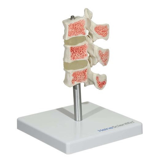 Osteoporosis Model - EconoMed