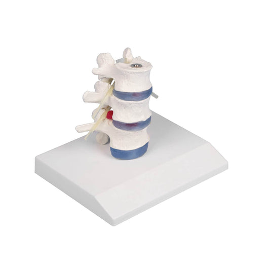 Lumbar Vertebra With Herniated Disc By Erler-Zimmer Mounted On A Stand (Removable)