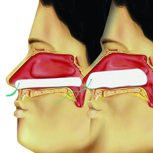 Sterile Raucocel Epistaxis Packing With Retrieval Thread. Available In 2 Sizes
